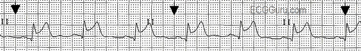 ecg-basics-normal-sinus-rhythm-with-st-segment-elevation-ecg-guru